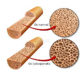 OsteoZinc Plus -PROFILAXIA ȘI TRATAMENTUL COMPLEX AL OSTEOPOROZEI